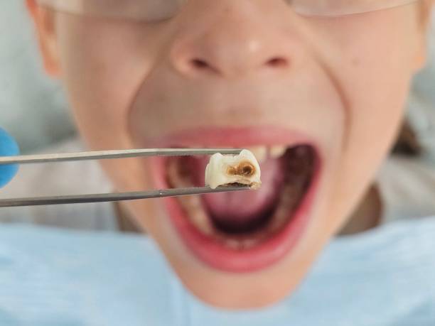 Teeth Whitening in VA